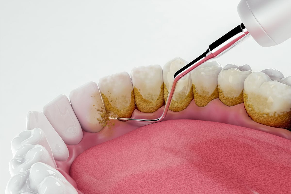 Periodontoloji