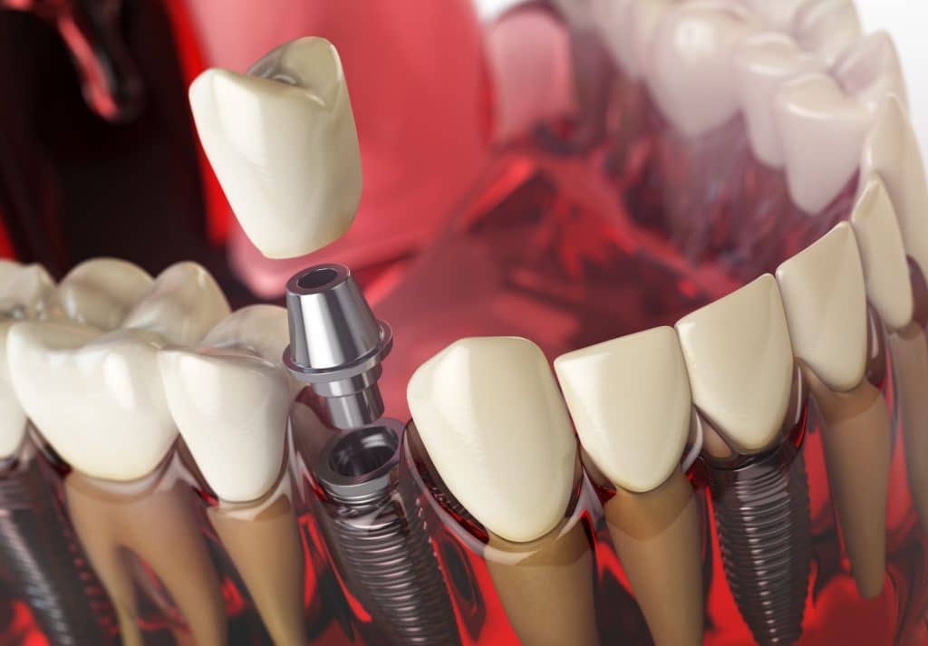 implant tedavisi