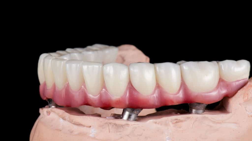 All on four implant