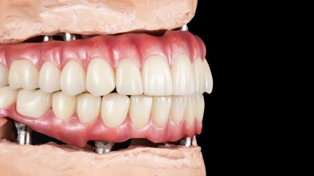 all on six implant