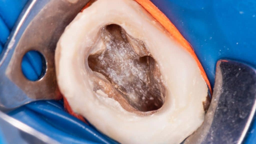 endodonti tedavisi