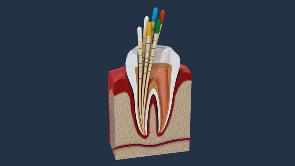 endodonti tedavisi