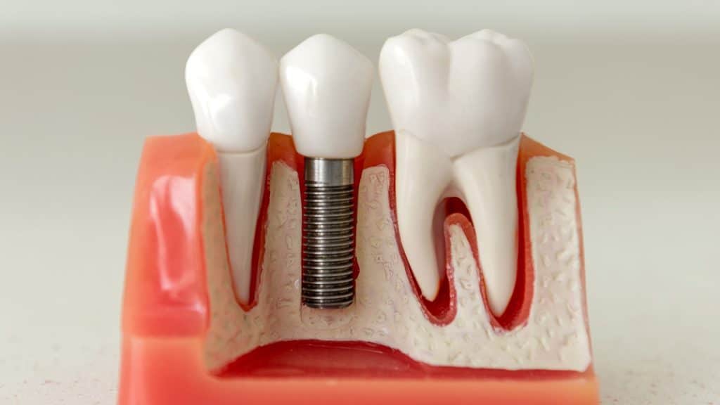 implant diş