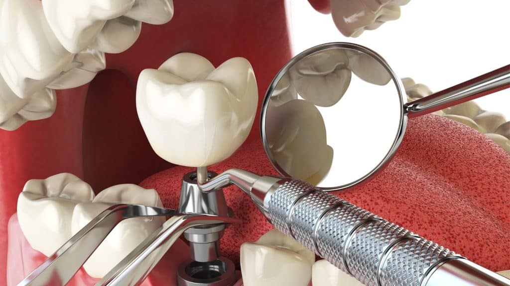 implant