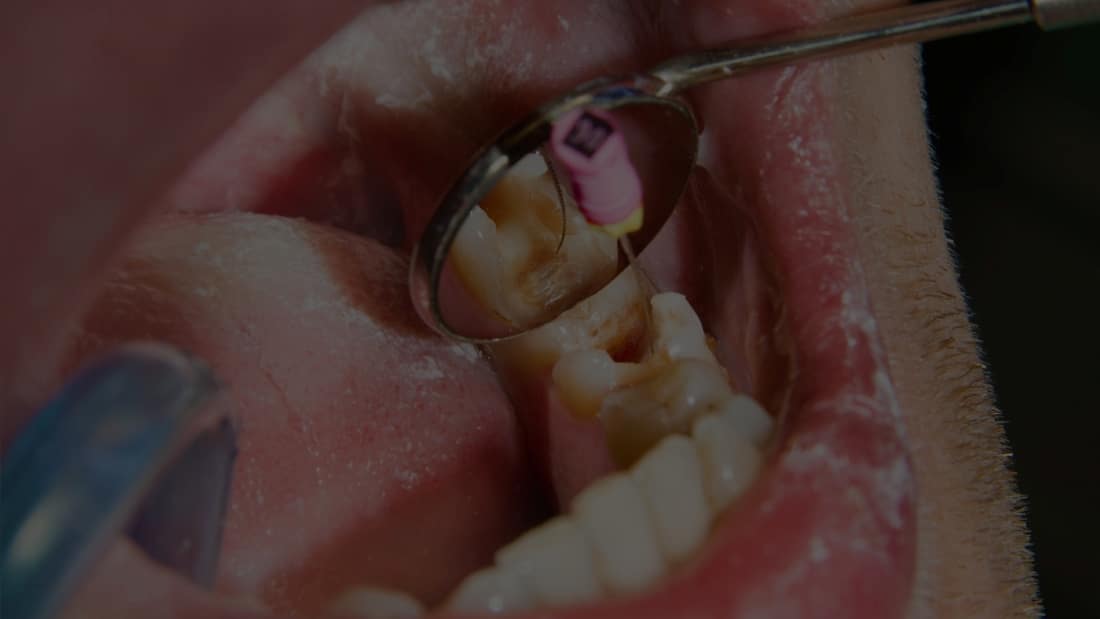 Kanal Tedavisi (Endodonti)