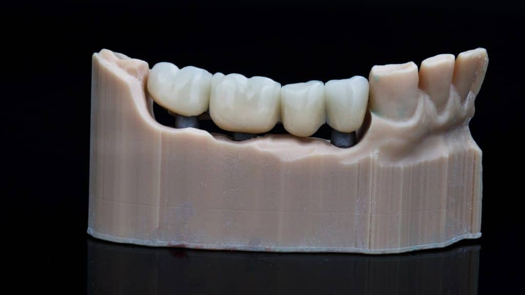 implant diş