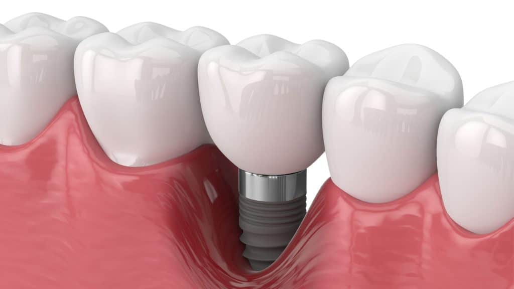 osseointegration