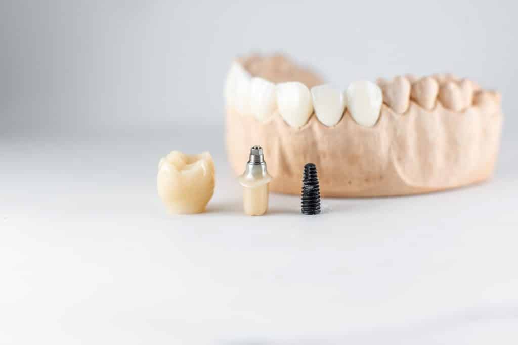 diş implantı