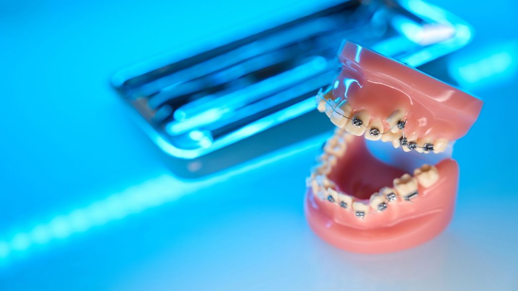 ortodontide şeffaf plak tedavisi yerine diş teli