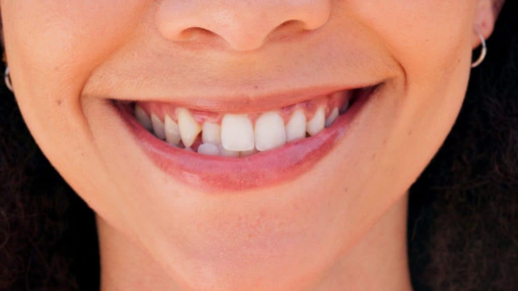 invisalign tedavisi olacak çapraşık dişlere sahip bir kadın
